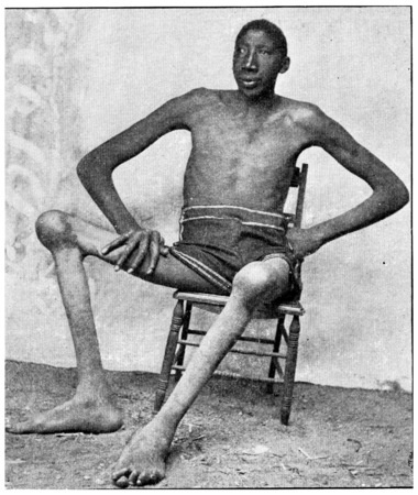 Man suffering from acromegaly