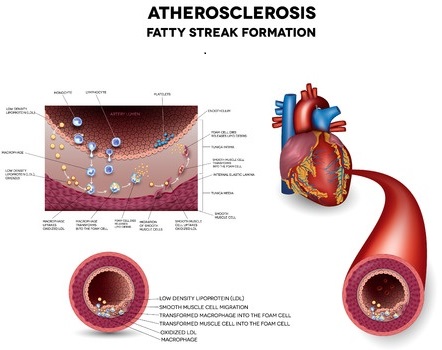 Atherosclerosis