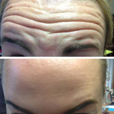 Botox Before After picture