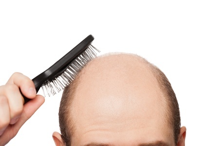 Hair Loss